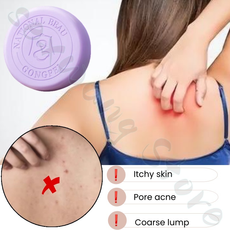Salicylic acid perilla demodex - đánh giá và giá Salicylic Acid Blackhead Remover
